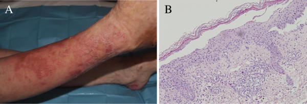 (A) Skin lesions affecting pretibial area. (B) Skin biopsy in necrolytic migratory erythema showing a zone of necrolysis and vacuolated keratinocytes[10]