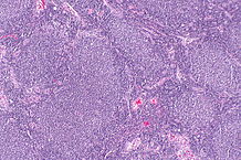 File:218px-Follicular lymphoma -- low mag.jpg