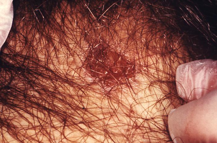 This female patient presented with a case of granuloma inguinale with coexisting secondary syphilis. See PHIL 3486 and 18895, for additional views of this patient's condition. Granuloma inguinale, like syphilis, is also a sexually transmitted disease. It is a slowly progressive ulcerative condition of the skin and lymphatics of the genital, and perianal area caused by infection with Calymmatobacterium granulomatis. Adapted from CDC
