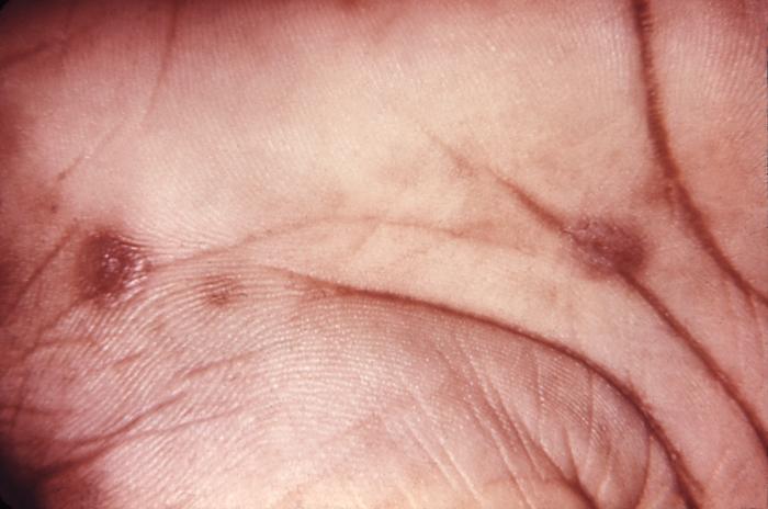 These are psoriaform lesions on the legs of a patient with secondary syphilis. The second stage starts when one or more areas of the skin break into a rash that appears as rough, red or reddish brown spots both on the palms of the hands and on the bottoms of the feet. Even without treatment, rashes clear up on their own. Note the secondary palmar syphilytic lesions on this syphilis patient. Syphilis is a complex sexually transmitted disease (STD) caused by the bacterium Treponema pallidum. It has often been called "the great imitator" because so many of the signs and symptoms are indistinguishable from those of other diseases. Adapted from CDC