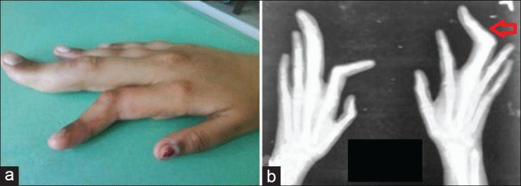 File:X-ray in Proteus Syndrome.gif