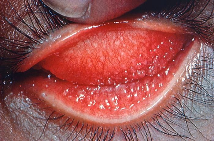 This image reveals a close view of a patient’s left eye with the upper lid retracted in order to reveal the inflamed conjunctival membrane lining the inside of both the upper and lower lids, due to what was determined to be a case of inclusion conjunctivitis, a type of conjunctival inflammation caused by the bacterium, Chlamydia trachomatis. Inclusion conjunctivitis, also known as chlamydial conjunctivitis, is more common in newborns. Symptoms include redness of the eye(s), swelling of the eyelids, and discharge of pus, usually 5 to 12 days after birth. Adapted from CDC