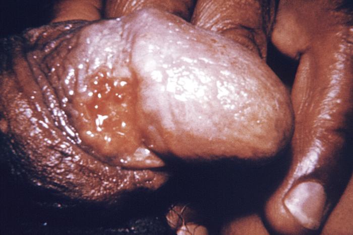 This male presented with a penile lesion that was found to be granuloma inguinale, also called “genital ulcerative disease”. From Public Health Image Library (PHIL). [4]
