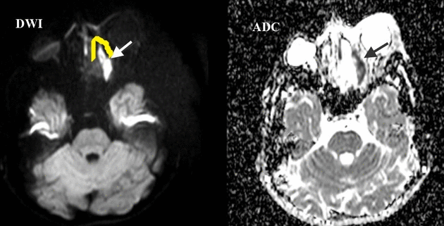 Orbital cellulitis with subperiosteal abscess on diffuse weighted imaging (DWI) MRI, showing apparent diffusion coefficient (ADC)