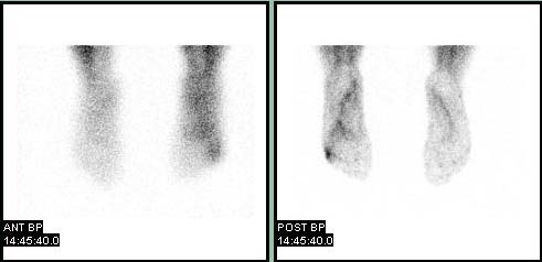 File:Osteomyelitis-102.jpg