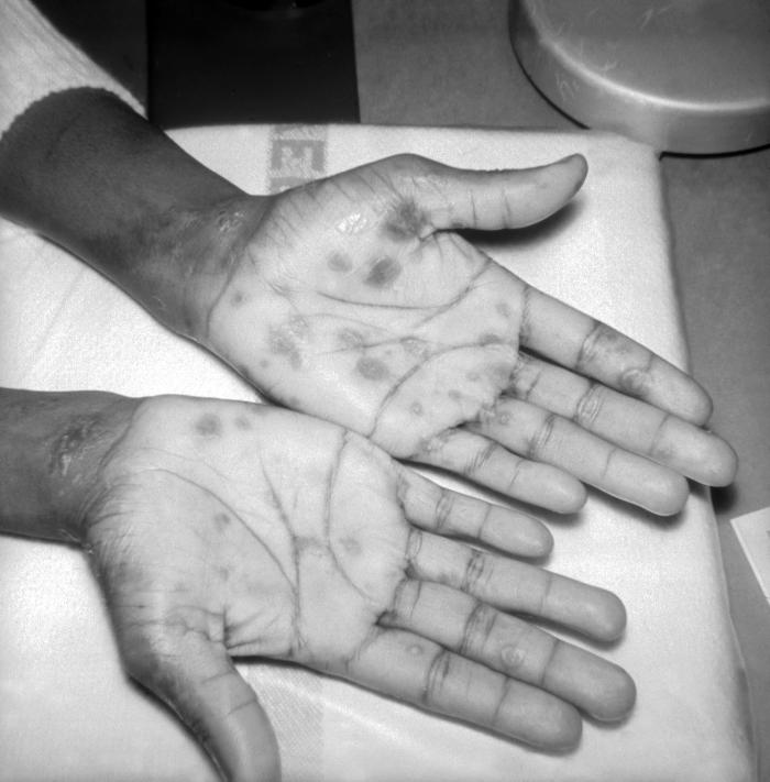A photograph of secondary syphilitic lesions on the back and right shoulder. These papulosquamous lesions on the back and shoulder developed during secondary syphilis. The rash often appears as rough, red or reddish brown spots that can appear on palms of hands, soles of feet, the chest and back, or other parts of the body. Adapted from CDC