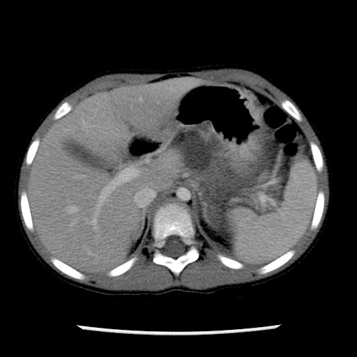 Computed Tomography: A patient with pancreatic transection and pseudocyst formation from motor vehicle accident