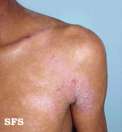 Atopic Dermatitis. Adapted from Dermatology Atlas.<ref name="Dermatology Atlas">{{Cite