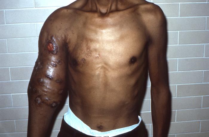 Patient with nocardiosis infection of his right upper arm due to Gram-positive Nocardia brasiliensis bacteria, which manifested into a cellulitic inflammation known as an actinomycotic mycetoma. From Public Health Image Library (PHIL). [3]