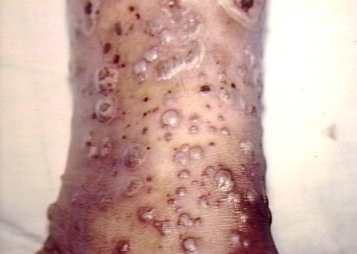 Leucocytoclastic vasculitis; pustular type