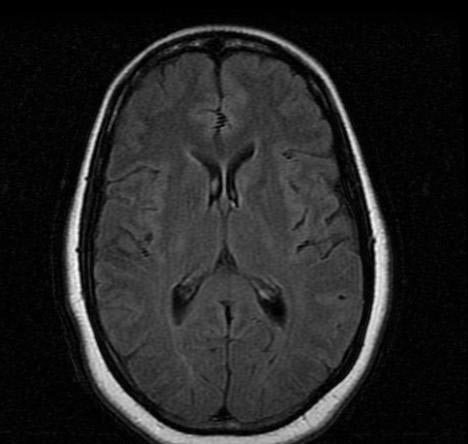File:Normal-brain-MRI-003.jpg