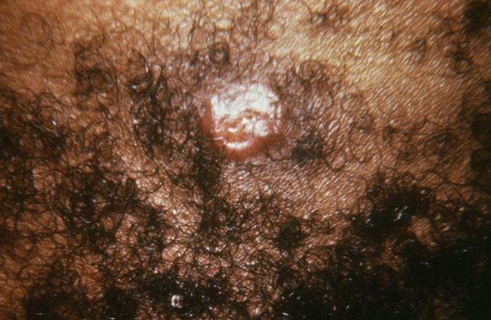 This patient presented with a gonorrheal ecthyma on the skin due to systemically disseminated N. gonorrhoeaebacteria.An ecthyma is a cutaneous eruption consisting of a large, round pustule on an inflamed base caused by untreated gonococcal bacteria spread systemically throughout the bloodstream.Adapted from CDC