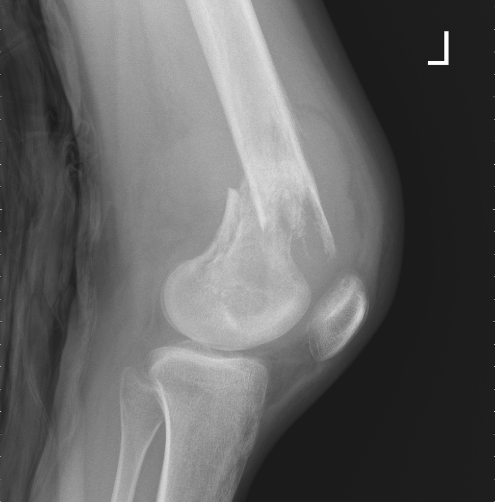 File:Pathological-femur-fracture (1).jpg