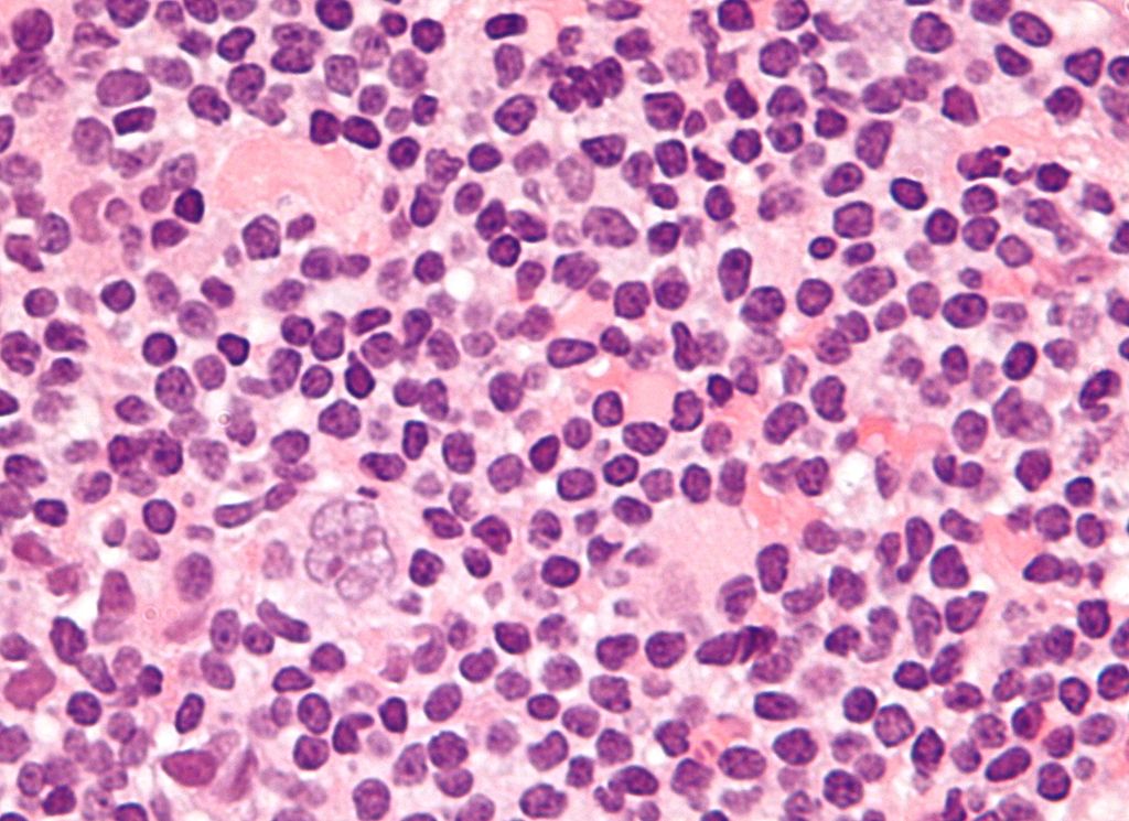File:Popcorn cell in nodular lymphocyte predominant Hodgkin lymphoma.jpg