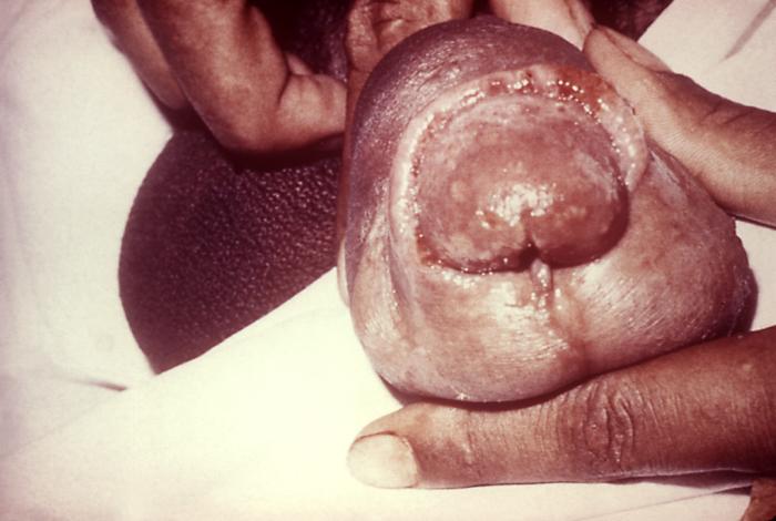 This patient presented with urogenital complications from a case of gonorrhea including penile paraphimosis.Due to the accompanying inflammation brought on by the Neisseria gonorrhoeae infection, the foreskin becomes adherent to the glans penis resulting in a condition known as phimosis, and cannot be retracted in order to expose the entire glans. Adapted from CDC