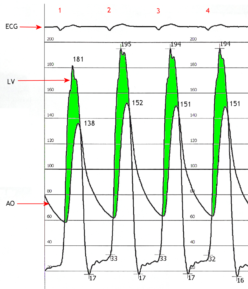 Simultaneous left ventricular and aortic pressure tracings demonstrate a pressure gradient between the left ventricle and aorta, suggesting aortic stenosis. The left ventricle generates higher pressures than what is transmitted to the aorta. The pressure gradient, caused by aortic stenosis, is represented by the green shaded area. (AO = ascending aorta; LV = left ventricle; ECG = electrocardiogram.) The heart may be catheterized to directly measure the pressure on both sides of the aortic valve. The pressure gradient may be used as a decision point for treatment. Catheterization is accurate for moderate velocity stenosis, while Doppler echo is more accurate at faster velocities.