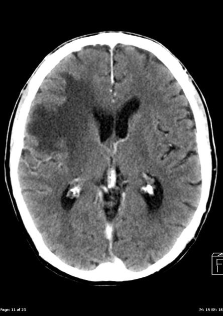 Contrast CT scan of a 85 year olf male with metastatic renal cell carcinoma, complaining of recent-onset headache, demonstrates a well-defined, vividly contrast enhancing mass identified in the right frontal lobe measuring 25 x 20 x 18 mm. The mass demonstrates a thick contrast-enhancing rim and a 6 x 6 mm focus of central hypodensity/necrosis. There is extensive surrounding vasogenic edema resulting in mass-effect with sulcal effacement, effacement of the right lateral ventricle, and 3 mm left-sided midline shift. No other mass, focal abnormality, intra or extra-axial collection is identified. Ventricles and basal cisterns are within normal limits and age appropriate.[11]