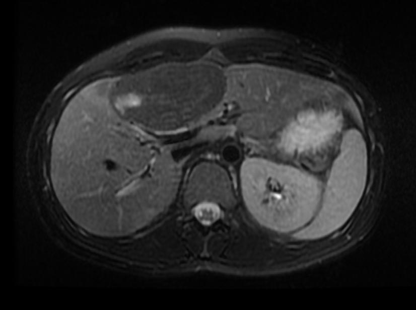 T2 Fat sat: A patient with multiple adenoma