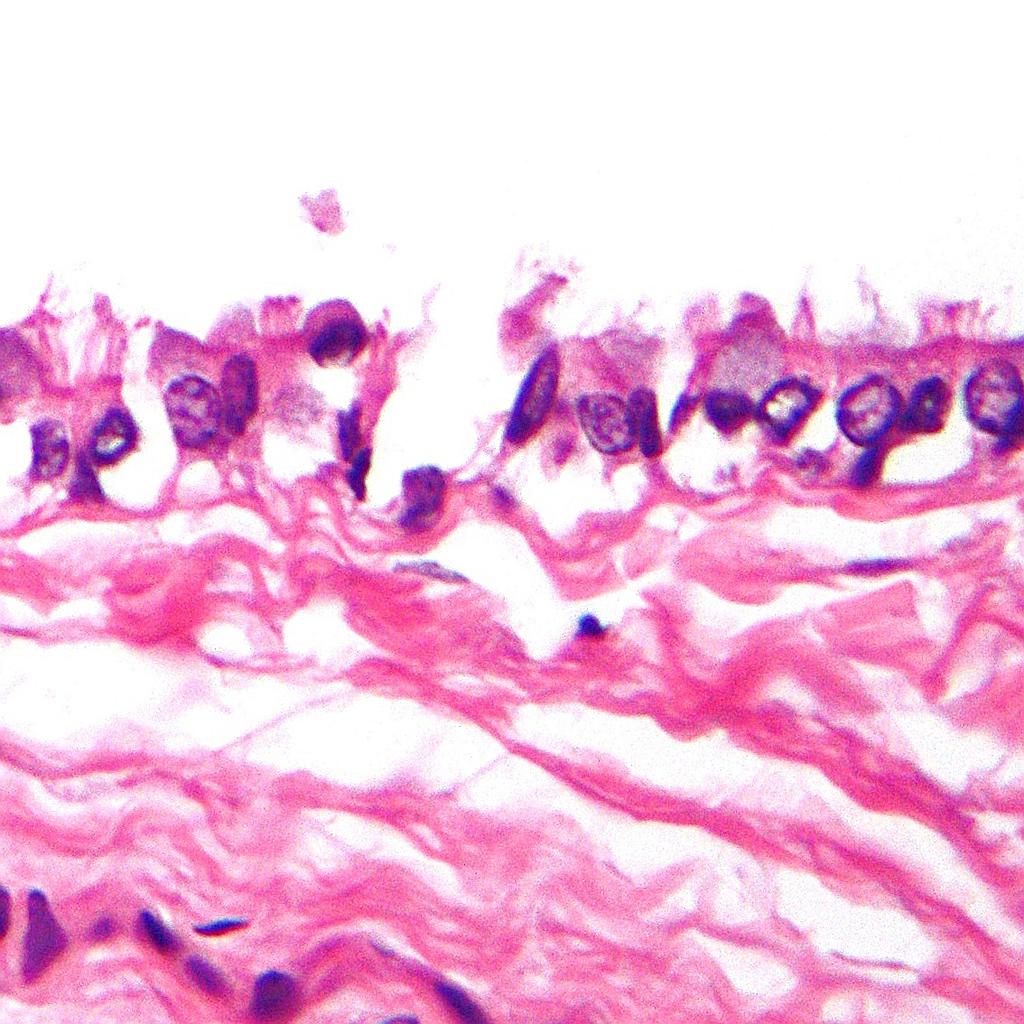 File:Histologic image of bronchogenic cyst showing cilia.jpg