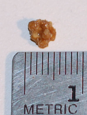 Kidney stone with a maximum dimension of 5mm, Source: Wikimedia commons[16]