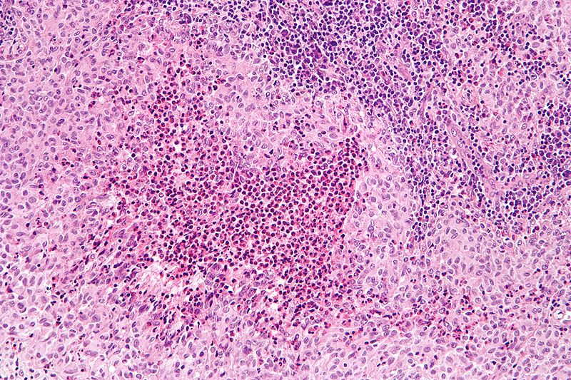 File:Langerhans cell histiocytosis - high mag.jpg