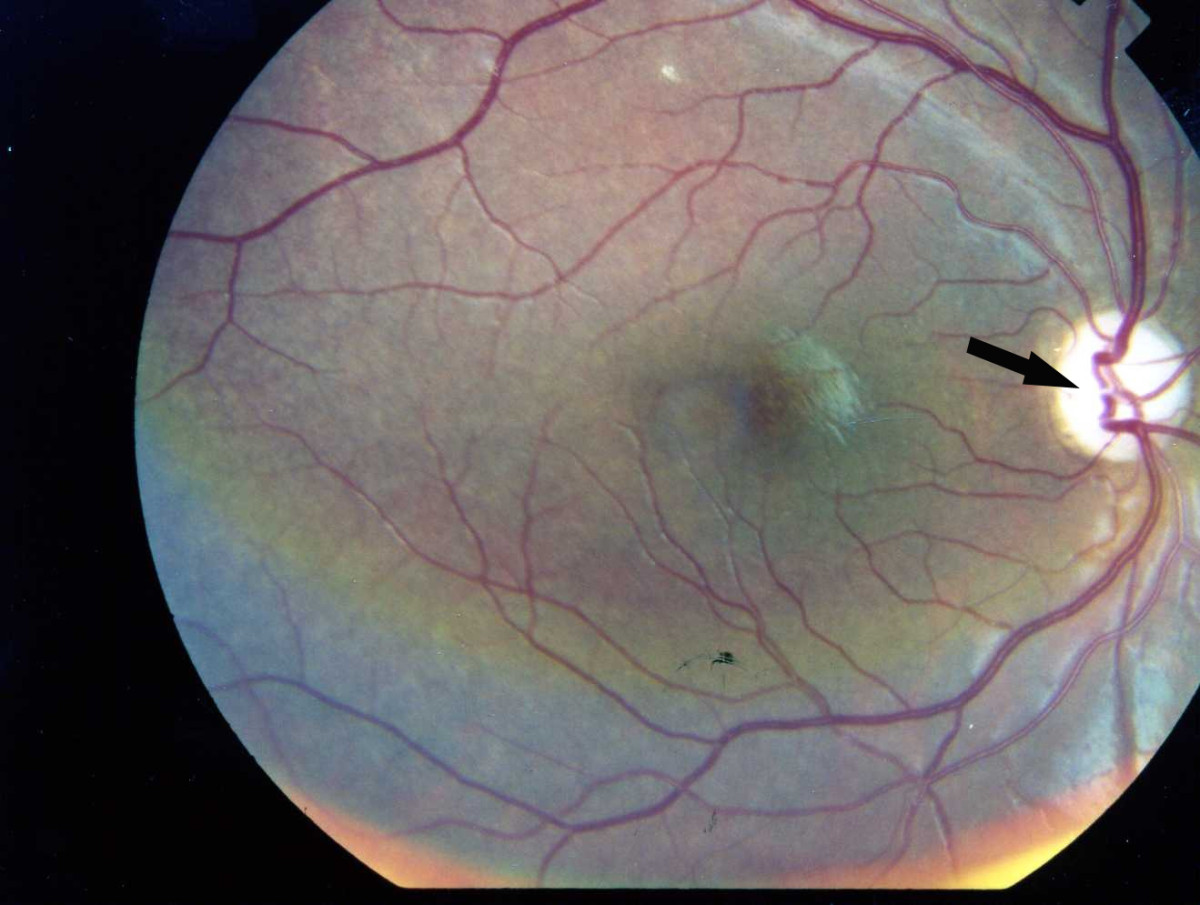 File:Photographic image of the patient right eye showing optic atrophy without diabetic retinopathy Wolfram syndrome.jpg