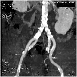 File:Renal artery stenosis 046.jpg