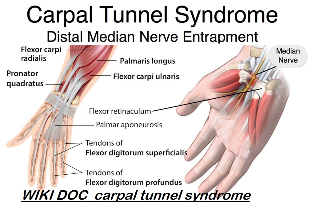 File:Carpal-tunnel-syndrome.jpg