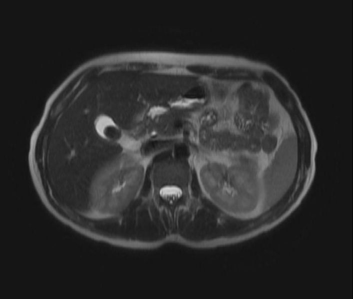 File:Cholelithiasis MRI 002.jpg