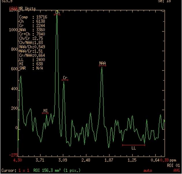 MR spectroscopy of the lesion demonstrating elevation of the choline and lipid lactate peaks and depression of the neural markers; N-acetyl aspartate (NAA) and creatine (Cr).[21]