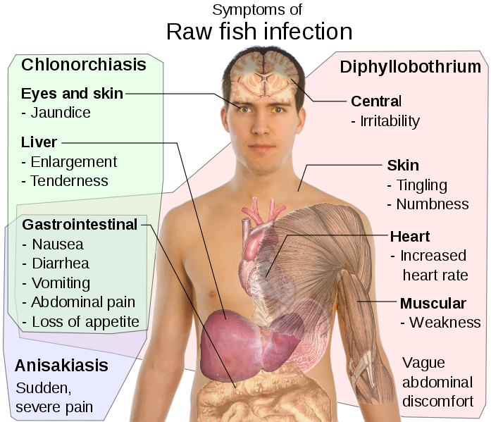 Symptoms of opisthorchiasis/clonorchiasis.