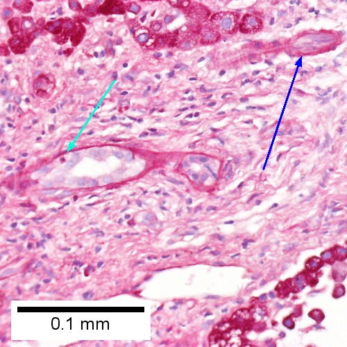 E. A PAS without diastase stain colors the arteriole (blue arrow), as well as the rim of the interlobular duct within which lies a neutrophil (cyan arrow).