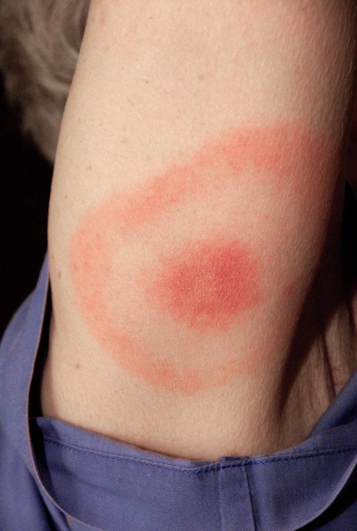 This 2007 photograph depicts the pathognomonic erythematous rash in the pattern of a “bull’s-eye”, which manifested at the site of a tick bite on this Maryland woman’s posterior right upper arm, who’d subsequently contracted Lyme disease From Public Health Image Library (PHIL). [1]