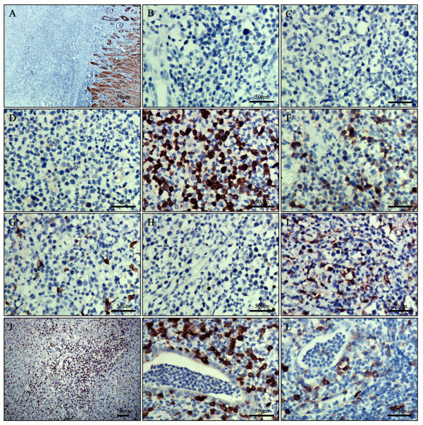 File:Enteropathy-associated T-cell lymphoma Immunohistochemical staining.jpg