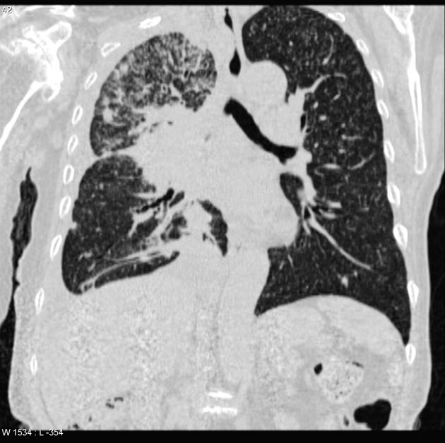 File:Miliary Tuberculosis CT.jpg