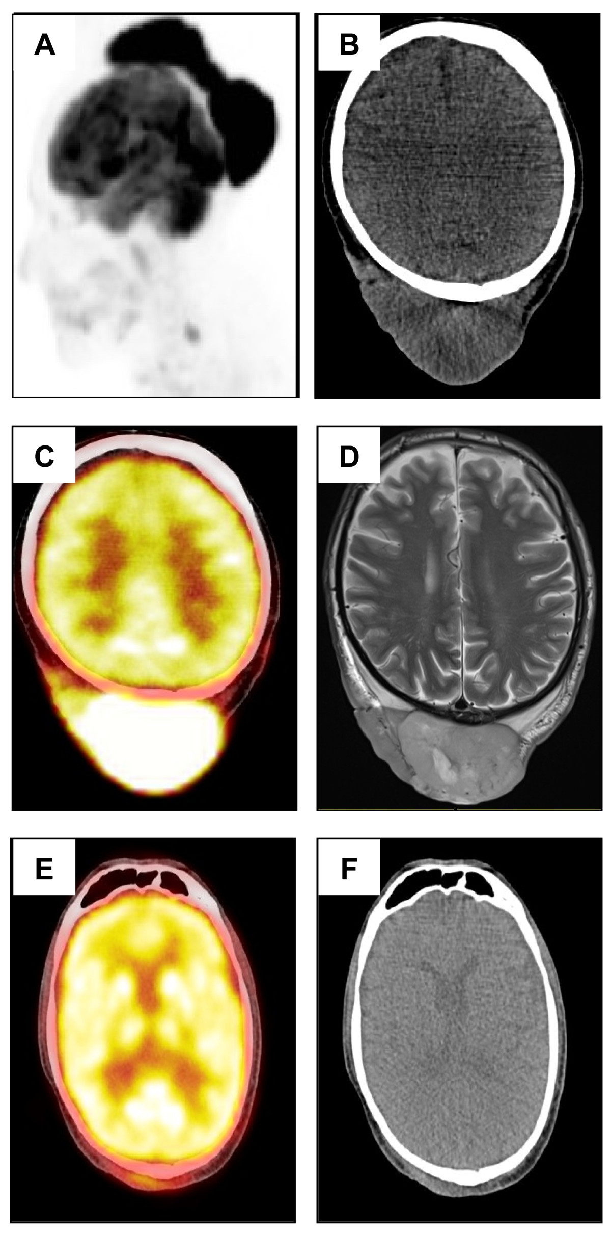 File:Primary cutaneous follicl centre lymphoma PET CT .jpg