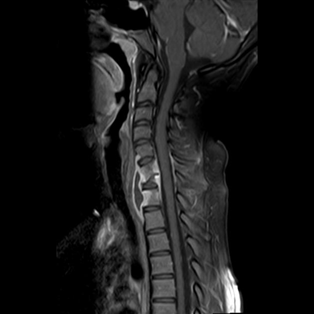 File:Spinal TB MRI.jpg