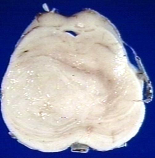 Brain: Glioma, Brain stem, Low Grade