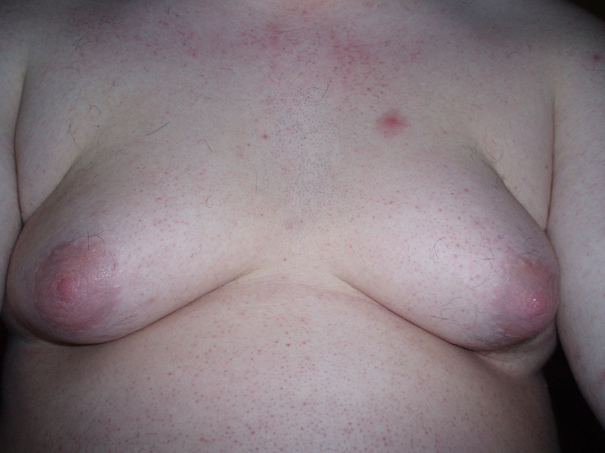 File:Gynecomastia 1.jpg