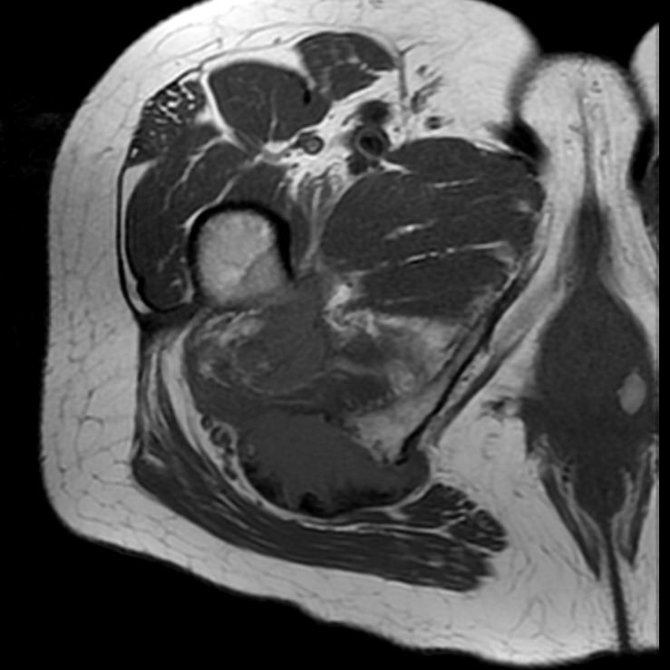 File:Hamstring tendon avulsion MRI 002.jpg
