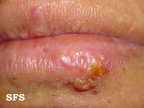 File:Herpes simplex 04.jpeg