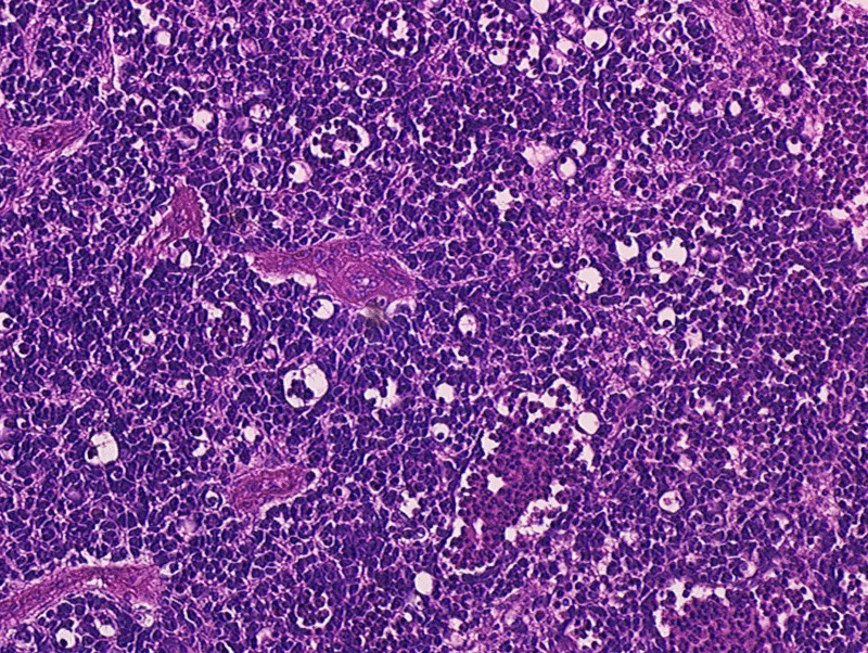 Retinoblastoma 400 X magnification[14]
