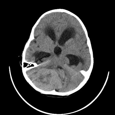 File:CT scan noncontrast medulloblastoma Dr Nasir Siddiqui.jpg