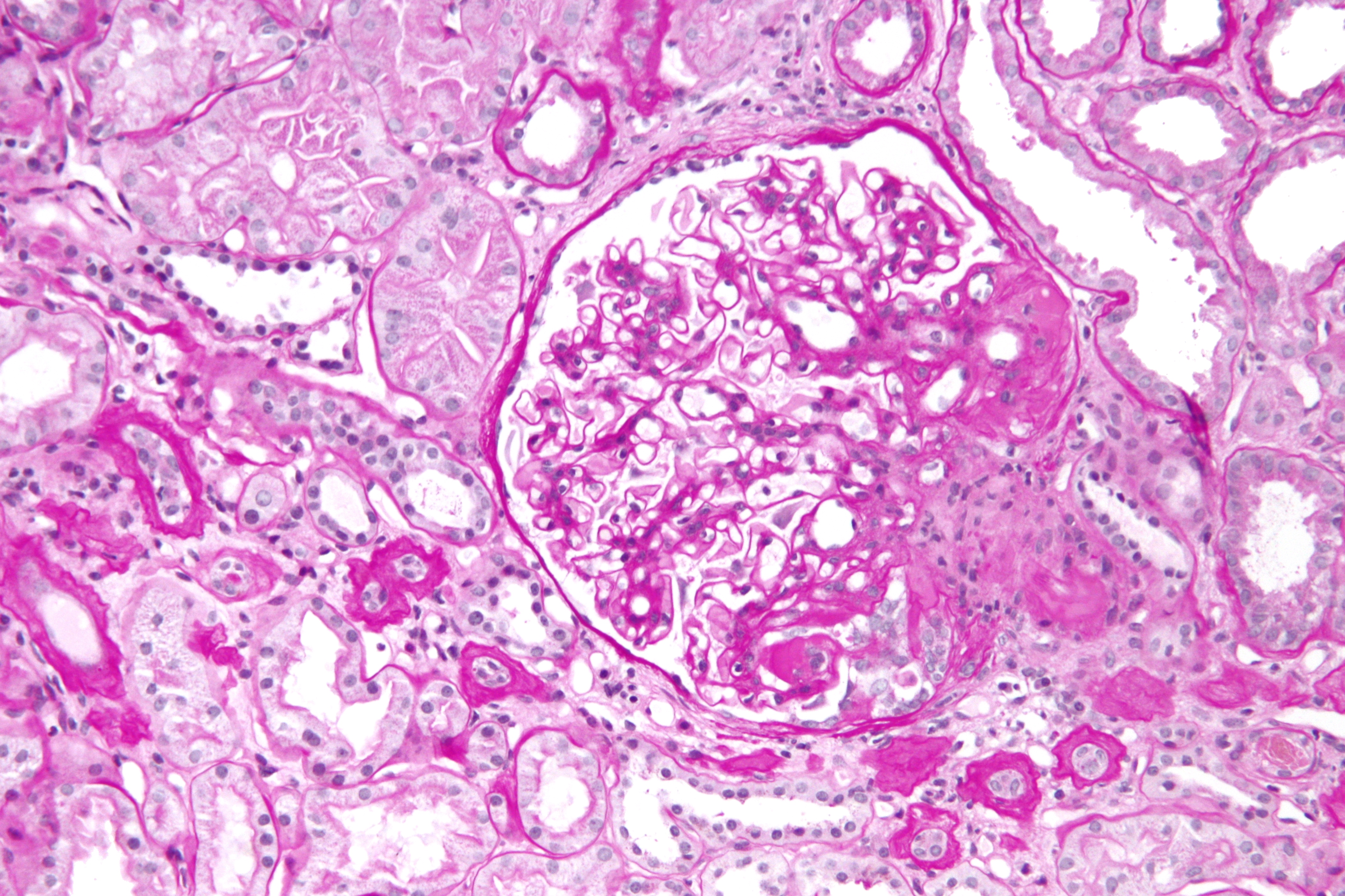 File:Focal segmental glomerulosclerosis - high mag.jpg