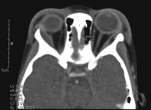 CT of the orbit in a patient with sickle cell disease. Shown is orbital wall infarction due to vaso-occlusive crisis. There is periorbital soft tissue edema.[1]