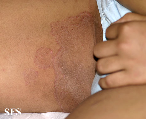 Tinea cruris. Adapted from Dermatology Atlas.[1]