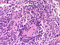 Adrenal neuroblastoma[8]