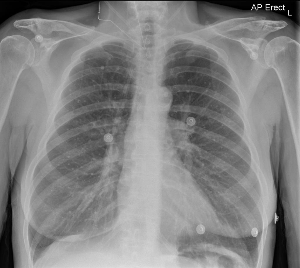 File:Healed varicella pneumonia - miliary opacities.jpg