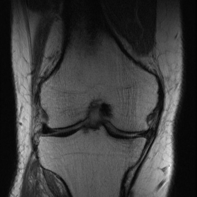 File:Mucoid degeneration of the anterio cruciate ligament MRI 003.jpg