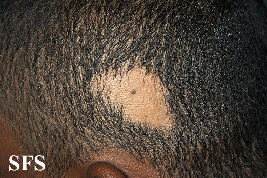 Alopecia acquisitum centrifugum. Adapted from Dermatology Atlas.[4]